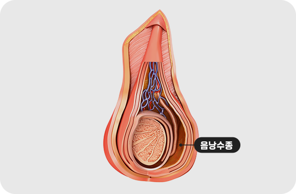 음낭수종